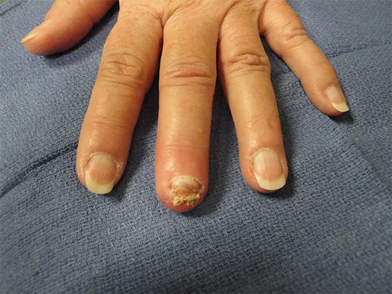Reconstruction Before & After Gallery - Patient 167367544 - Image 4