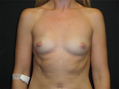 Breast Implant Reconstruction Before & After Gallery - Patient 167370104 - Image 1