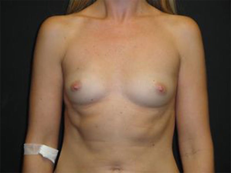 Breast Implant Reconstruction Before & After Gallery - Patient 167370104 - Image 1