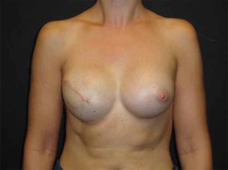 Breast Implant Reconstruction Before & After Gallery - Patient 167370104 - Image 2