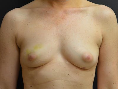 Breast Implant Reconstruction Before & After Gallery - Patient 167370153 - Image 1