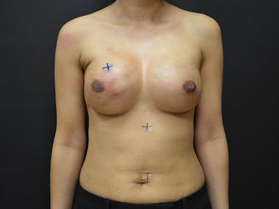 Breast Implant Reconstruction Before & After Gallery - Patient 167370154 - Image 2