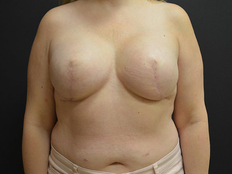 Breast Implant Reconstruction Before & After Gallery - Patient 167370167 - Image 2