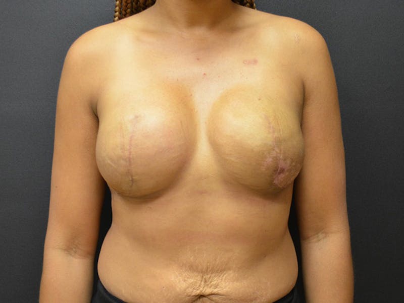 Breast Implant Reconstruction Before & After Gallery - Patient 167370196 - Image 2