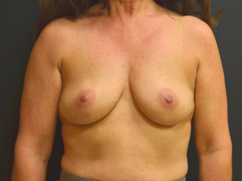 Breast Implant Reconstruction Before & After Gallery - Patient 167370199 - Image 1