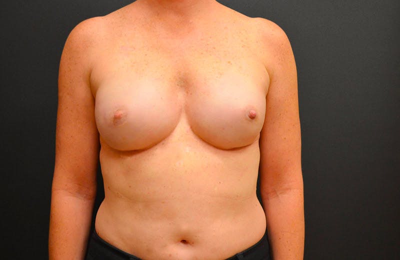 Breast Implant Reconstruction Before & After Gallery - Patient 167370202 - Image 2