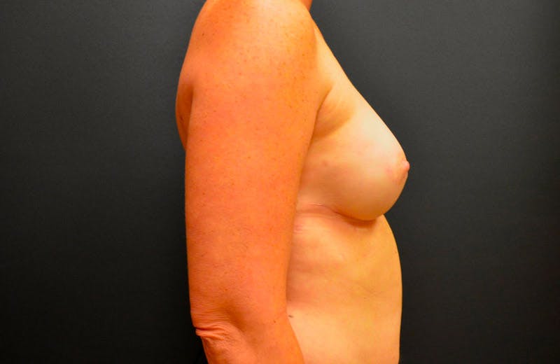 Breast Implant Reconstruction Before & After Gallery - Patient 167370202 - Image 4