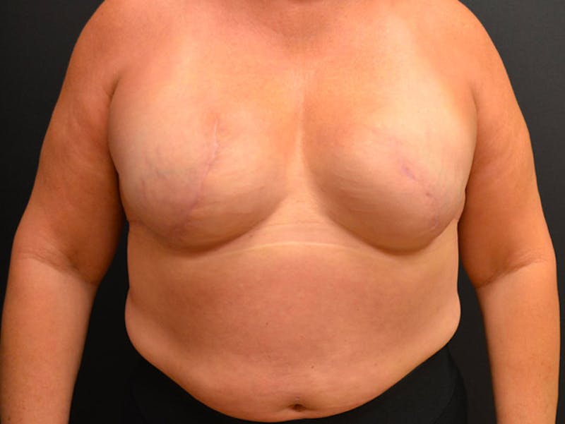 Breast Implant Reconstruction Before & After Gallery - Patient 167373848 - Image 2