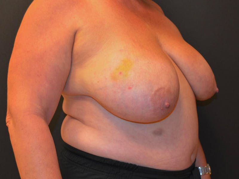 Breast Implant Reconstruction Before & After Gallery - Patient 167373848 - Image 3
