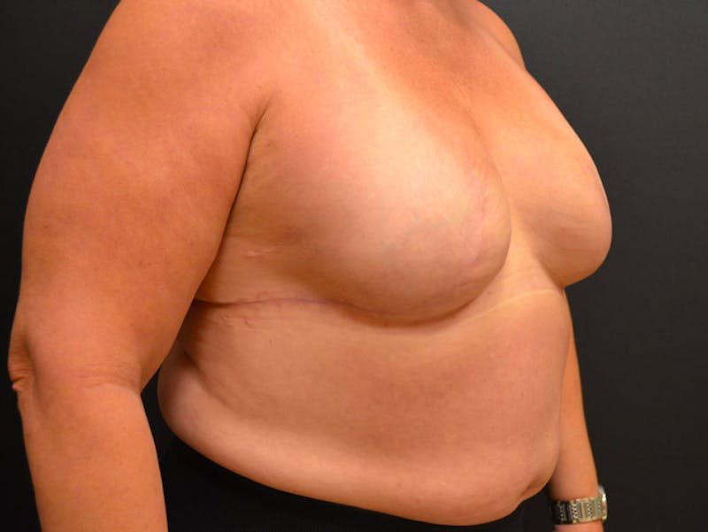 Breast Implant Reconstruction Before & After Gallery - Patient 167373848 - Image 4