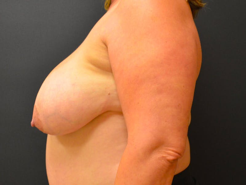 Breast Implant Reconstruction Before & After Gallery - Patient 167373848 - Image 5