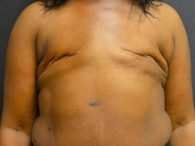 Breast Implant Reconstruction Before & After Gallery - Patient 167373869 - Image 1