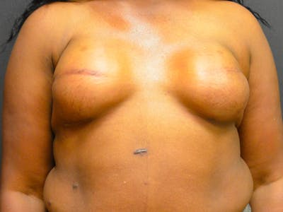 Breast Implant Reconstruction Before & After Gallery - Patient 167373869 - Image 2