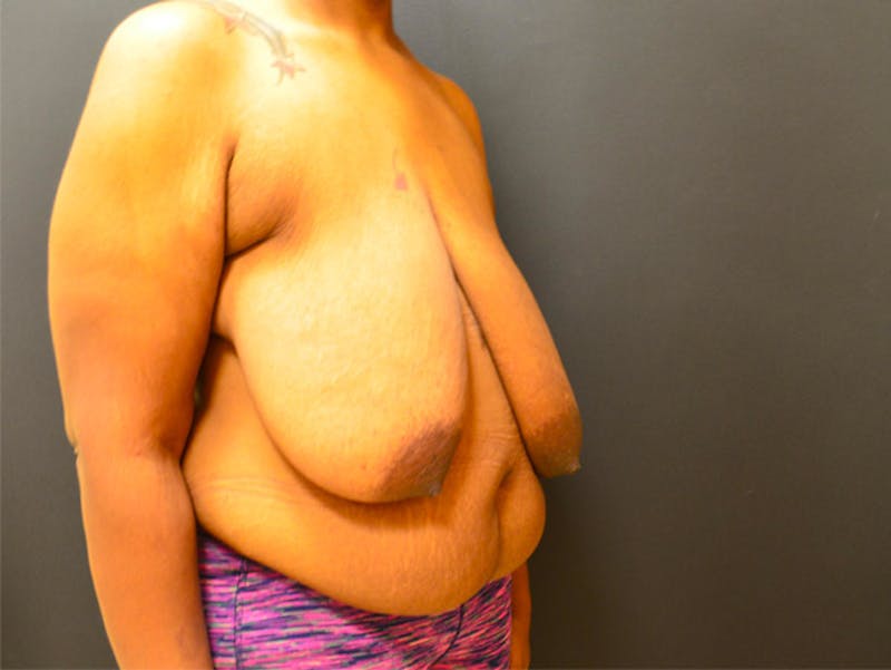 Breast Implant Reconstruction Before & After Gallery - Patient 167373888 - Image 1