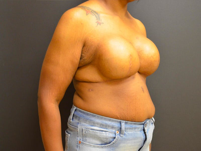 Breast Implant Reconstruction Before & After Gallery - Patient 167373888 - Image 2