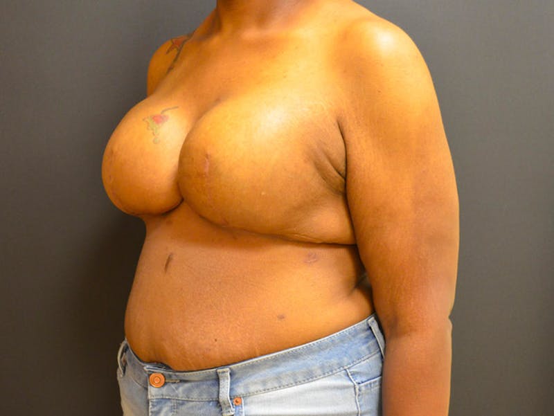 Breast Implant Reconstruction Before & After Gallery - Patient 167373888 - Image 4