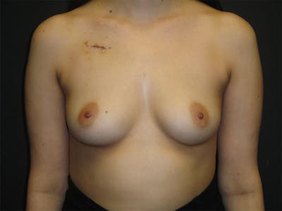 Breast Implant Reconstruction Before & After Gallery - Patient 167373930 - Image 1