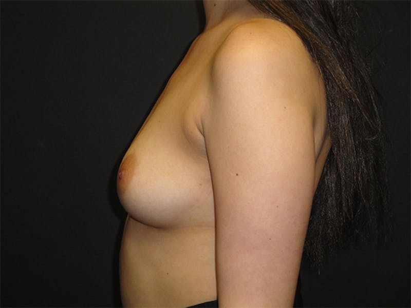 Breast Implant Reconstruction Before & After Gallery - Patient 167373930 - Image 3