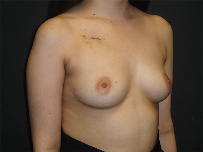 Breast Implant Reconstruction Before & After Gallery - Patient 167373930 - Image 5
