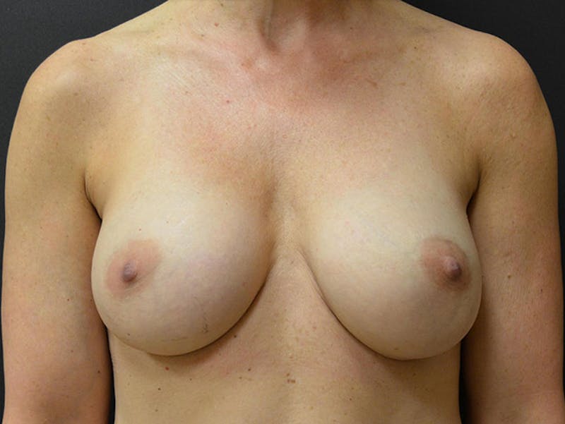 Breast Implant Reconstruction Before & After Gallery - Patient 167373937 - Image 1