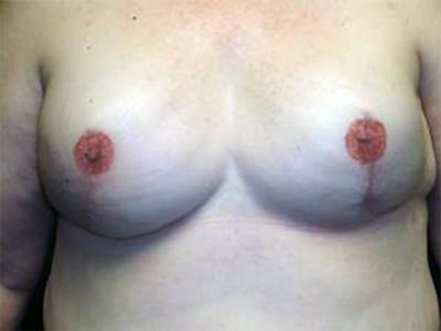 Breast Implant Reconstruction Before & After Gallery - Patient 167373999 - Image 2