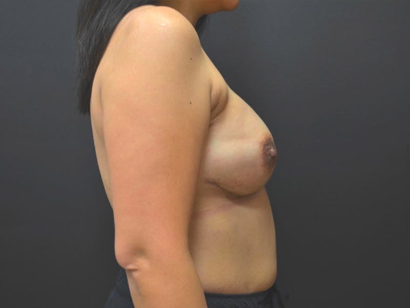 Breast Implant Reconstruction Before & After Gallery - Patient 167374001 - Image 4