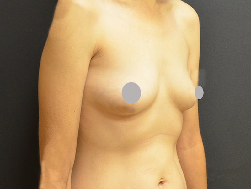 Breast Implant Reconstruction Before & After Gallery - Patient 167374032 - Image 1
