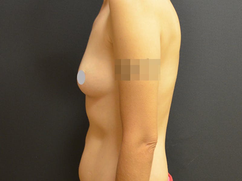 Breast Implant Reconstruction Before & After Gallery - Patient 167374032 - Image 3