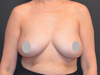 Breast Implant Reconstruction Before & After Gallery - Patient 167374038 - Image 1