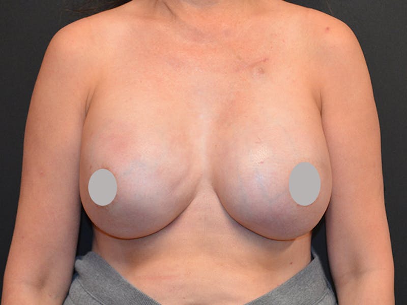 Breast Implant Reconstruction Before & After Gallery - Patient 167374038 - Image 2