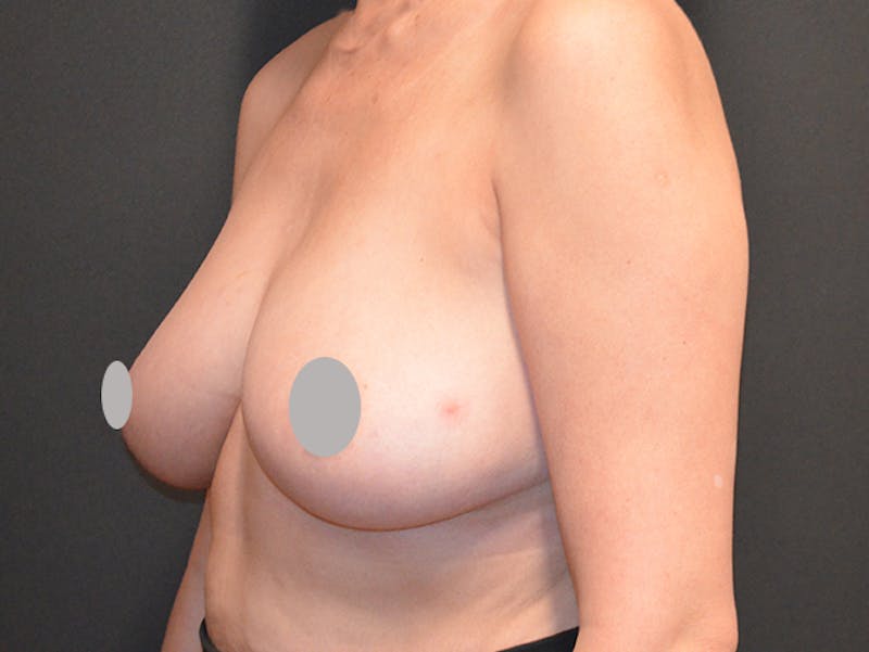 Breast Implant Reconstruction Before & After Gallery - Patient 167374038 - Image 3