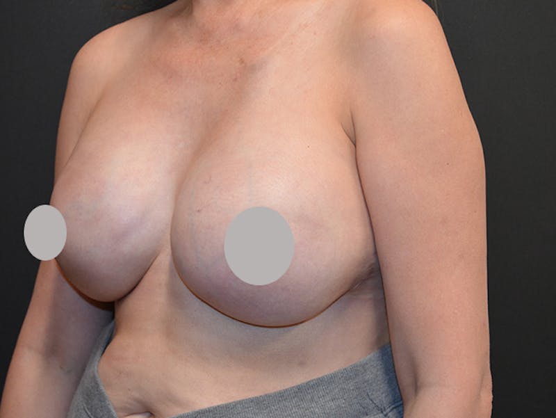 Breast Implant Reconstruction Before & After Gallery - Patient 167374038 - Image 4
