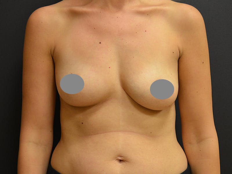 Breast Implant Reconstruction Before & After Gallery - Patient 167374061 - Image 1