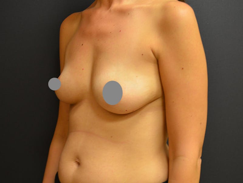 Breast Implant Reconstruction Before & After Gallery - Patient 167374061 - Image 5
