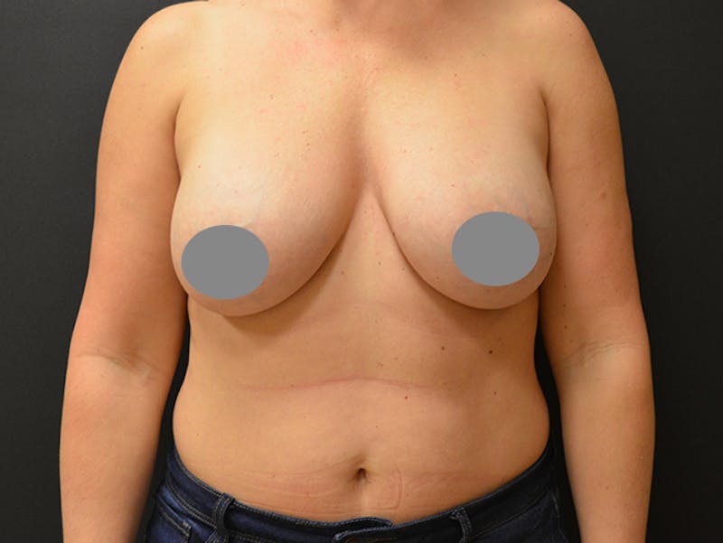 Breast Implant Reconstruction Before & After Gallery - Patient 167374085 - Image 1