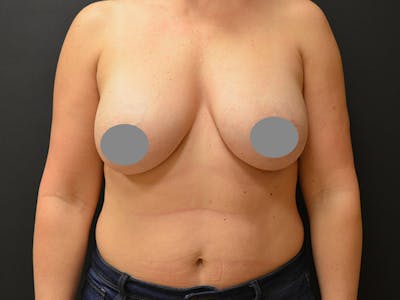 Breast Implant Reconstruction Before & After Gallery - Patient 167374085 - Image 1