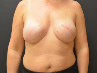Breast Implant Reconstruction Before & After Gallery - Patient 167374085 - Image 2