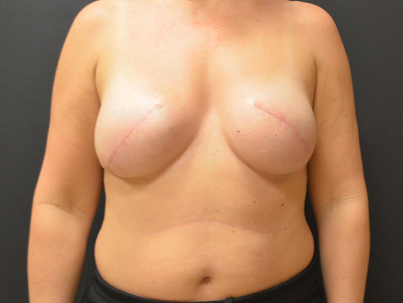 Breast Implant Reconstruction Before & After Gallery - Patient 167374085 - Image 2