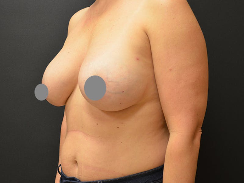 Breast Implant Reconstruction Before & After Gallery - Patient 167374085 - Image 5