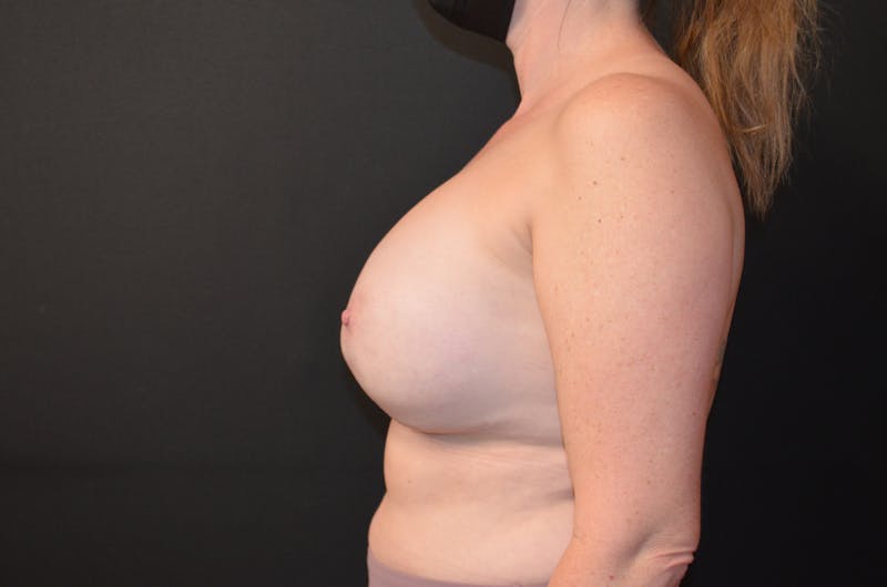 Breast Revision Before & After Gallery - Patient 189118302 - Image 3
