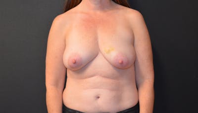 Breast Implant Reconstruction Before & After Gallery - Patient 189119651 - Image 1