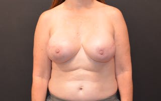Breast Implant Reconstruction Before & After Gallery - Patient 189119651 - Image 2