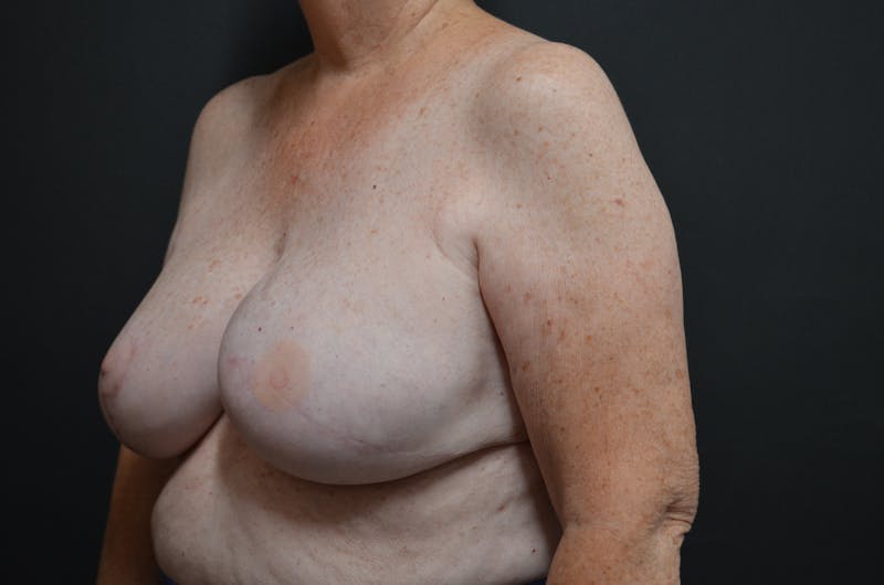 Breast Flap Reconstruction Before & After Gallery - Patient 189142415 - Image 4