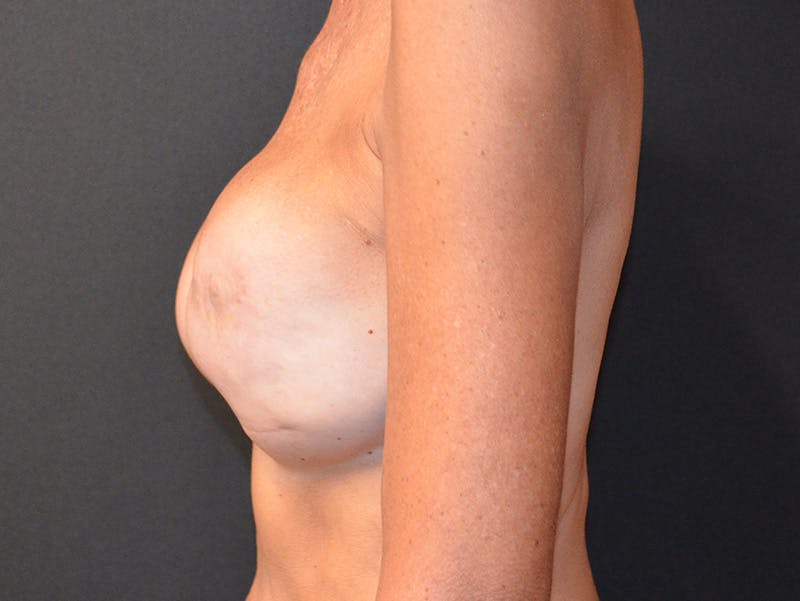 Breast Implant Reconstruction Before & After Gallery - Patient 331537 - Image 9