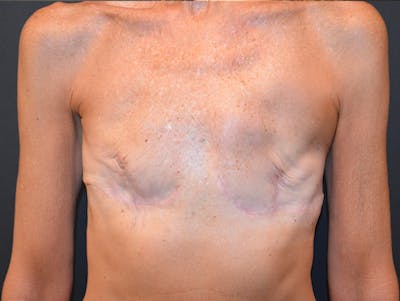 Breast Implant Reconstruction Before & After Gallery - Patient 331537 - Image 2