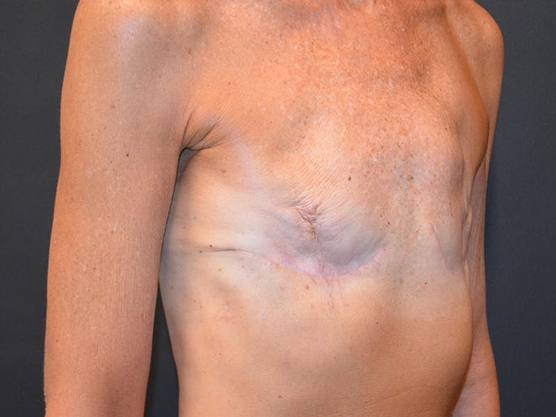 Breast Implant Reconstruction Before & After Gallery - Patient 331537 - Image 4