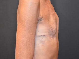 Breast Implant Reconstruction Before & After Gallery - Patient 331537 - Image 6