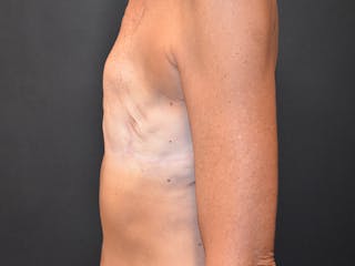 Breast Implant Reconstruction Before & After Gallery - Patient 331537 - Image 10