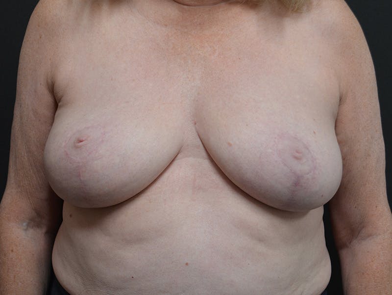 Breast Reconstruction Before & After Gallery - Patient 978215 - Image 2