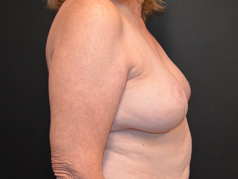 Breast Reconstruction Before & After Gallery - Patient 978215 - Image 4